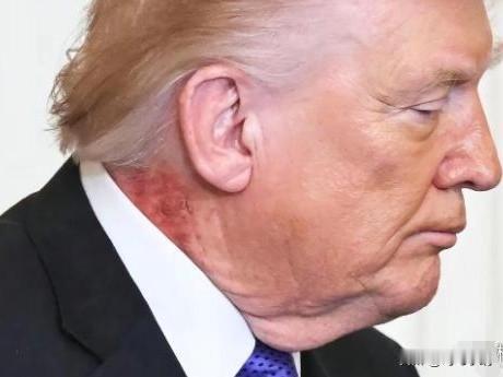 从特朗普脖子和手上的病变情况判断，他或许都等不到伊朗那边的“圣火令”了。
在美国