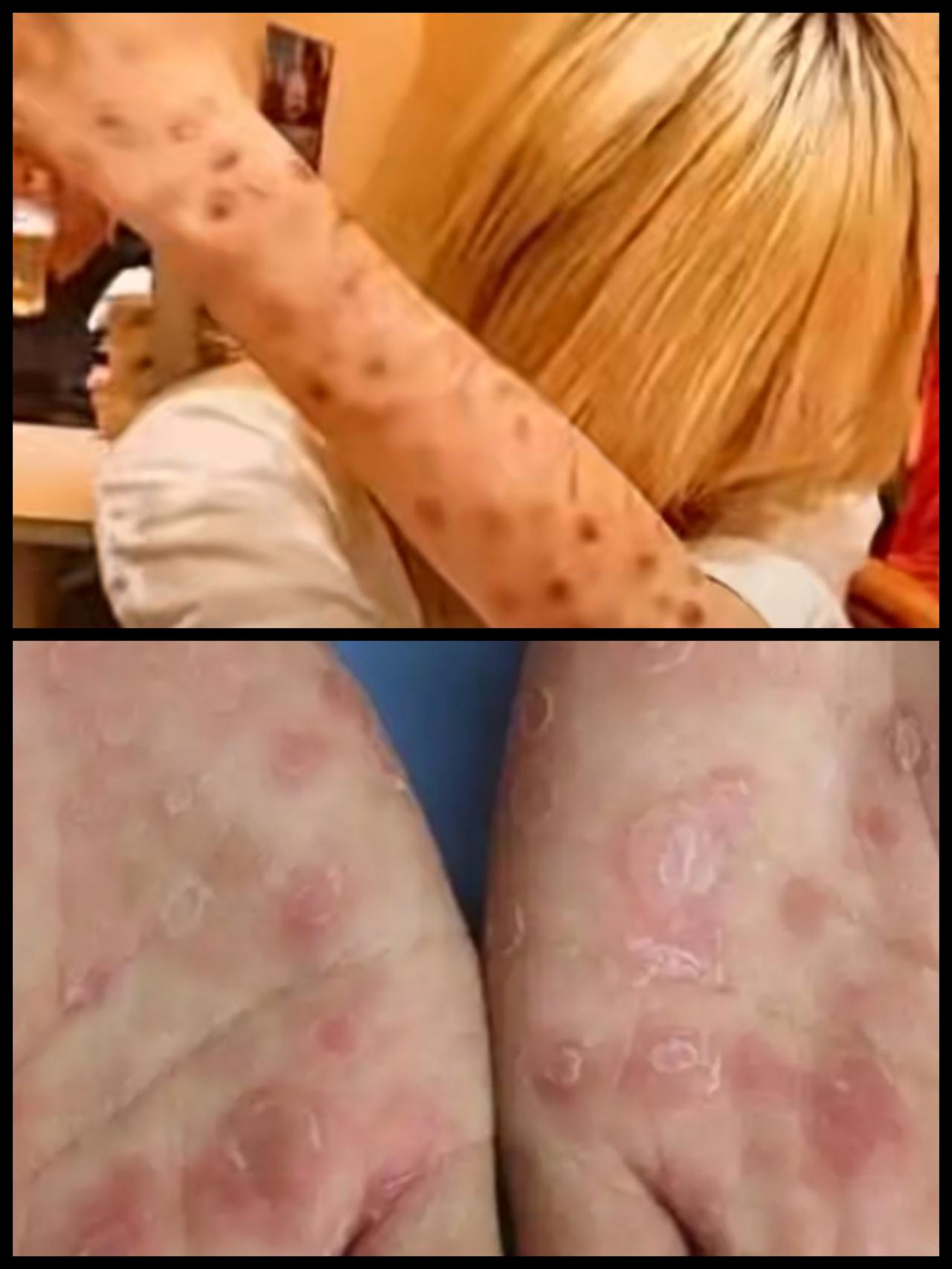 日本真成毒国了，该国梅毒感染大暴发，严竣情况引发邻国担忧。日本在2022年报告病