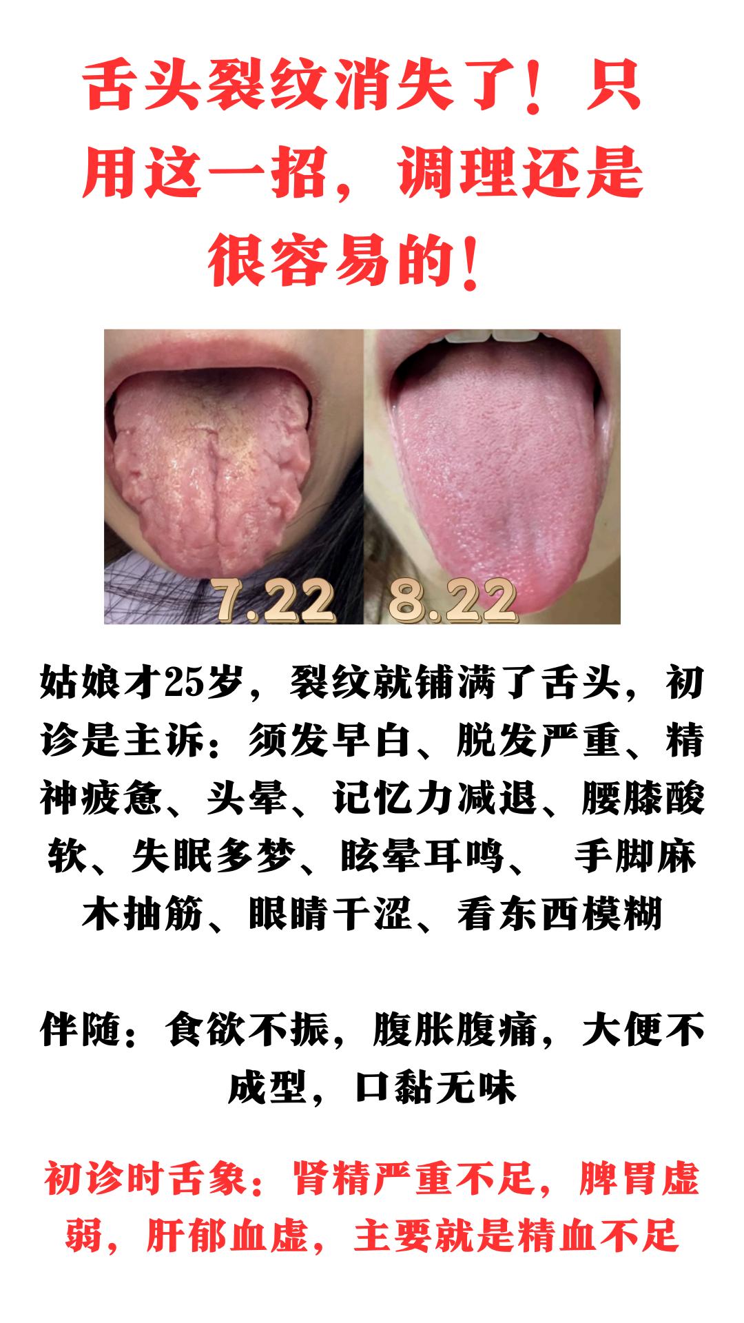 舌头裂纹消失了！只用这一招，调理还是很容易的！#中药##健康科普##中医##舌诊