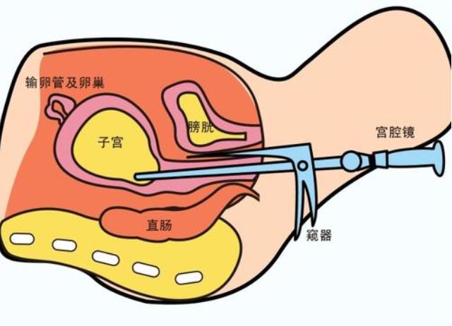 #健康真探社#【宫腔镜检查对怀孕有什么影响？】在门诊经常听到一些女性朋友说：“我