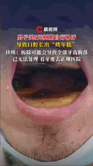 9月2号，天津，一男子为了省钱，在网上买了5块钱的树脂，竟然自己去补牙，但没想到