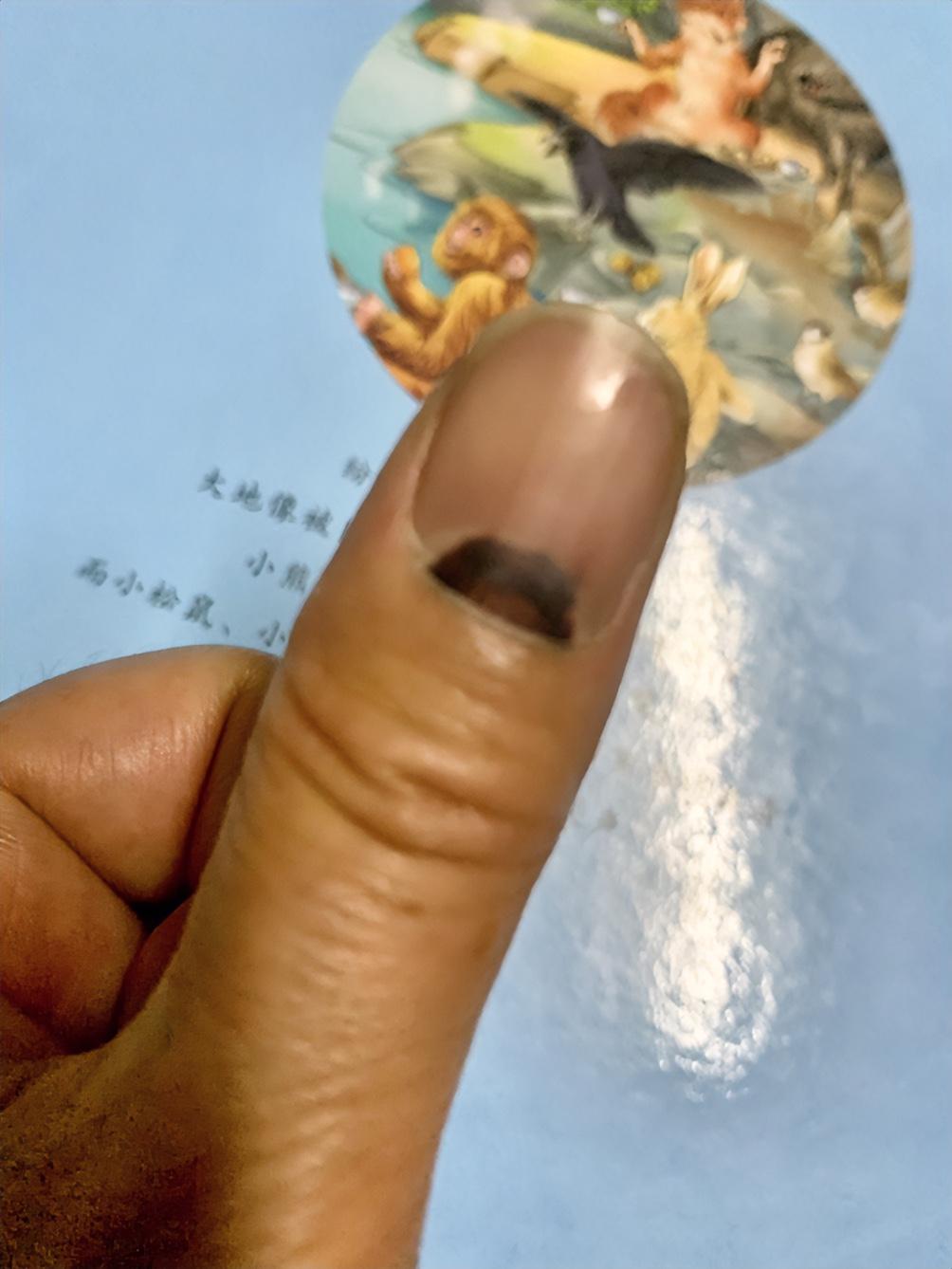 指甲被夹后出现黑紫色，怎么缓解疼痛？
前天中午关门不慎夹到大拇指，片刻后指甲四分