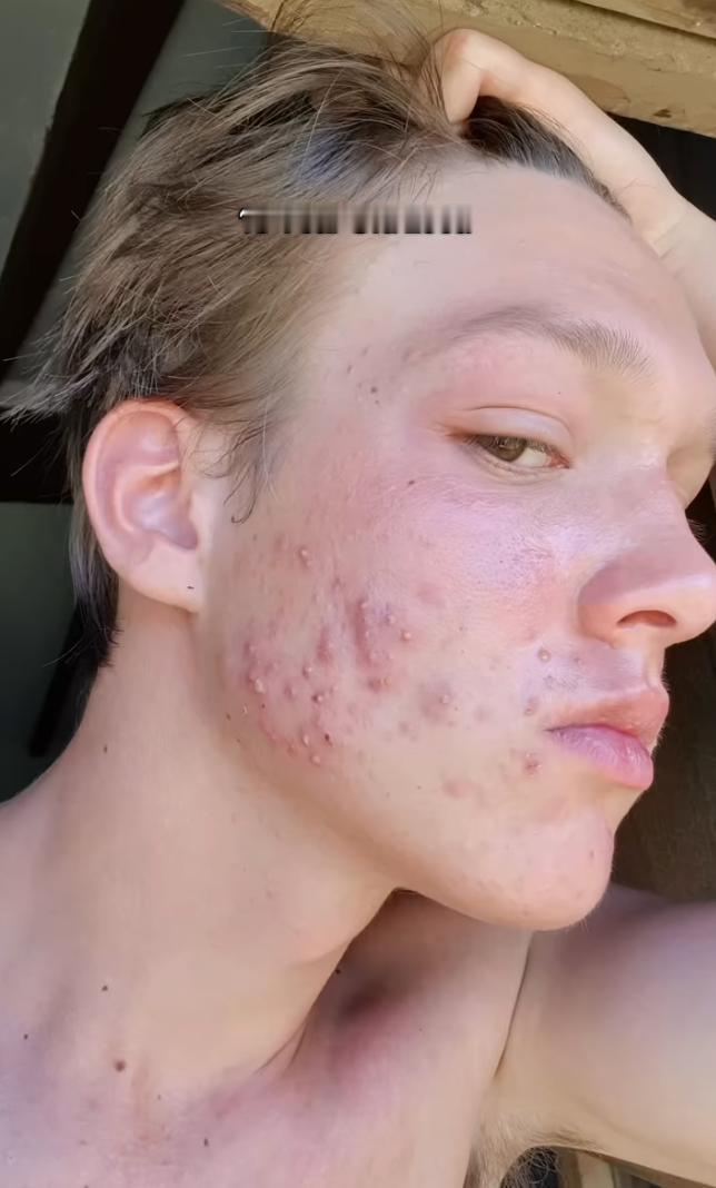 美妆博主 Luca Mornet  透露自己以前是油痘肌，曾经一度自卑！
肌肤状