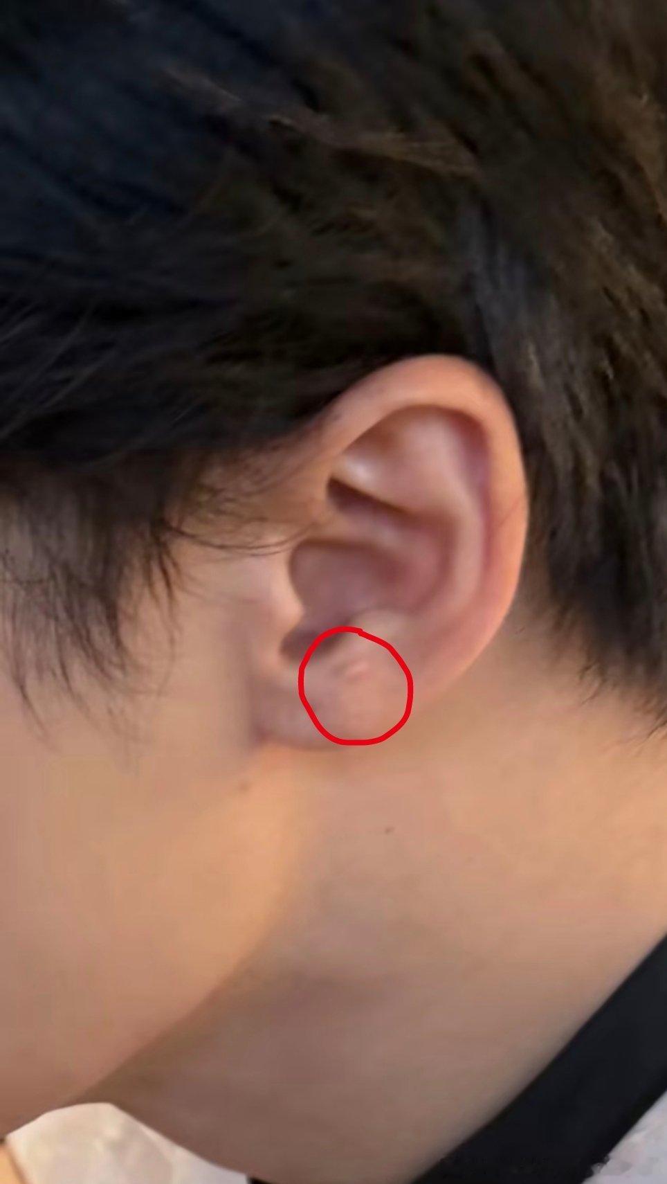 这块是健次耳朵被炸掉后留下的疤吗？好干净漂亮的👂🏻 