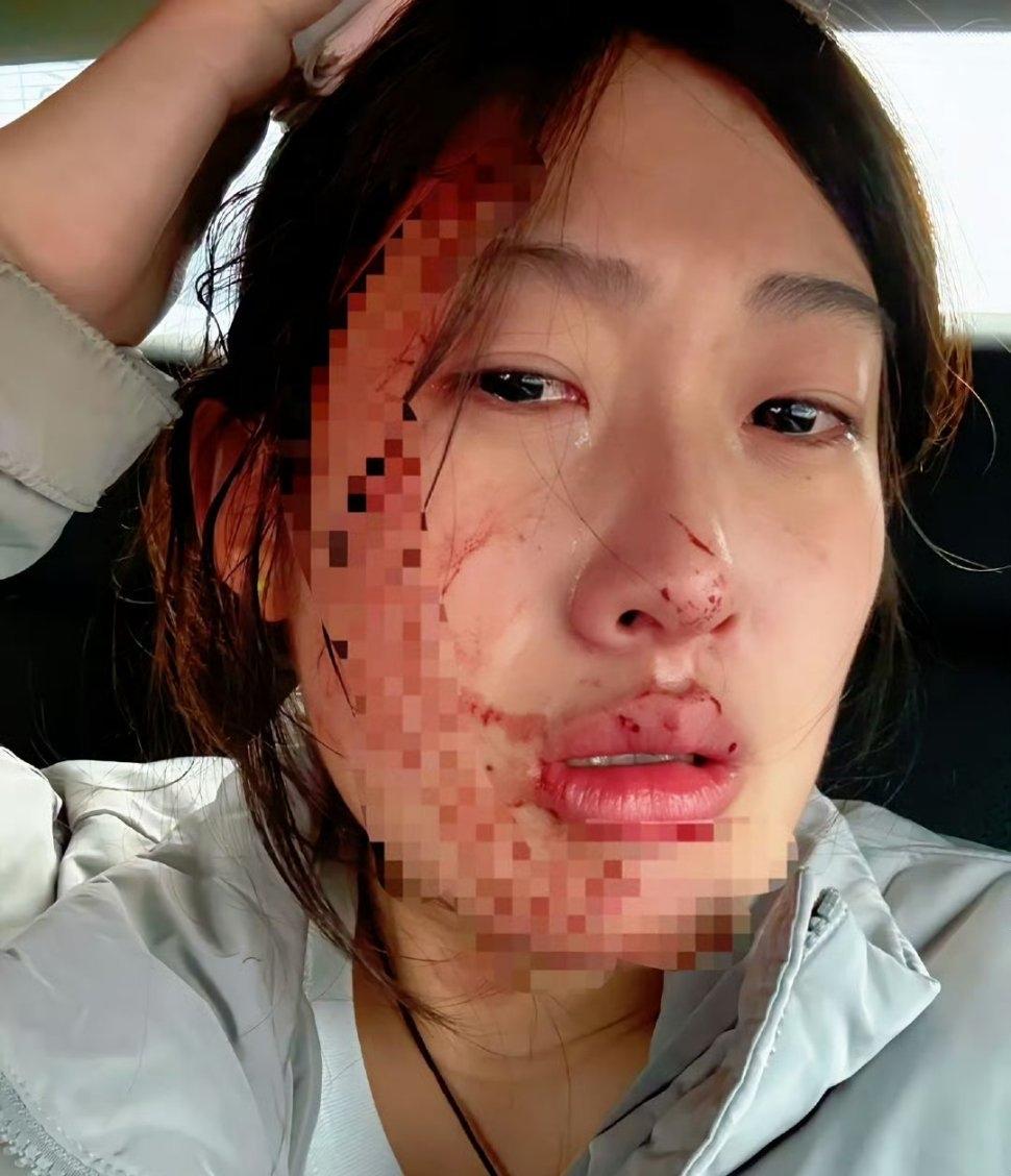 【护士因患儿输液失败遭家属殴打】

近日，河北秦皇岛某医院一名23岁护士在为感冒