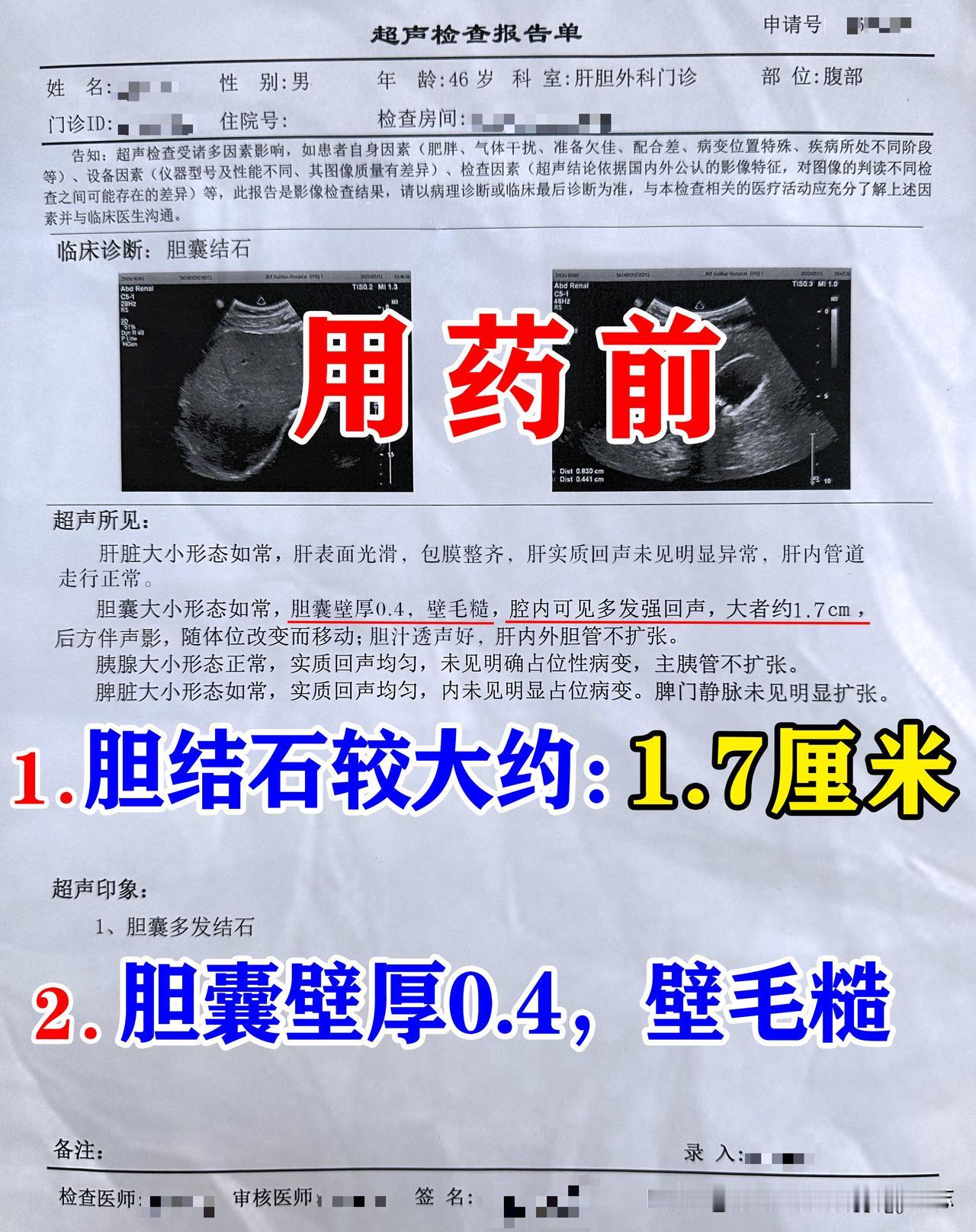 这位患者当时差一点就做了手术，单位体检时发现有胆结石，多发胆结石，较大的1.7c