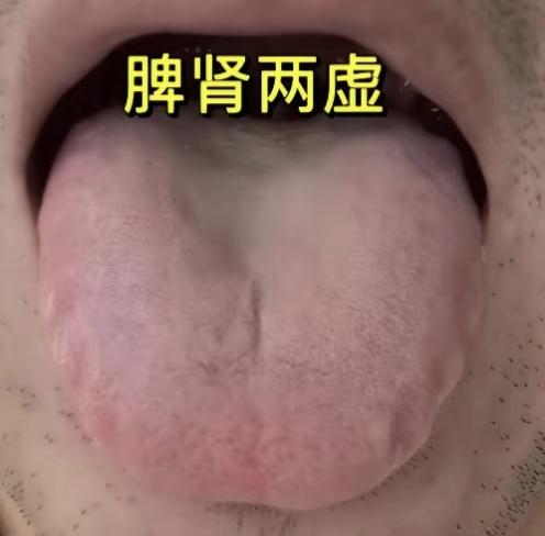 脾肾两虚的舌象、症状和方剂对应特别精准！舌根凹陷（肾虚）+ 舌边齿痕（脾虚），搭
