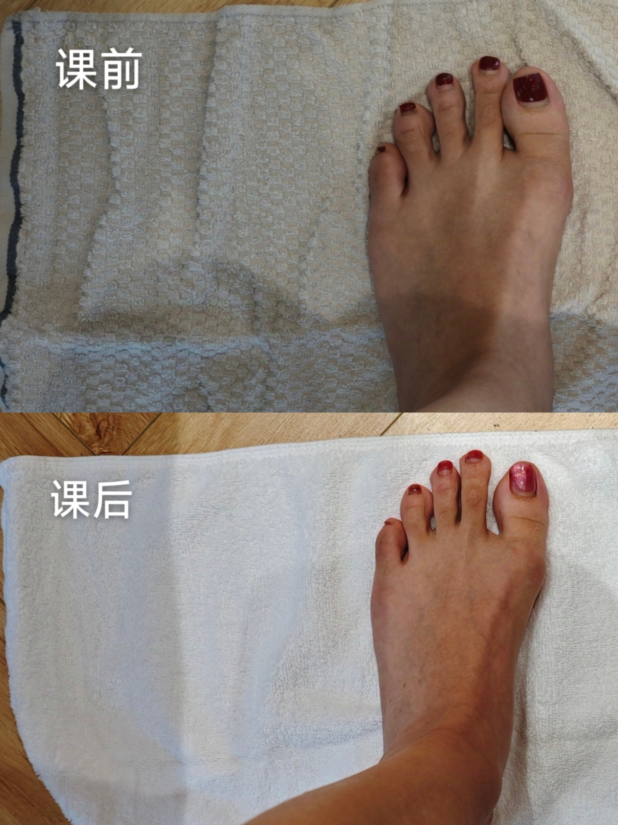 拇外翻  来看你的脚，会不会也这样？深圳店的一位患者，左侧踇外翻已经6年多了，长