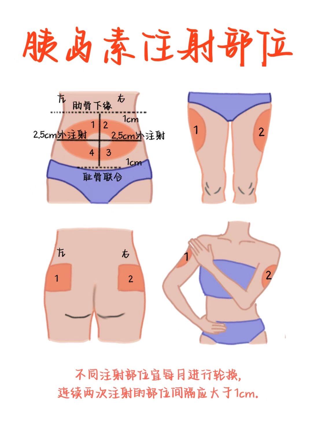 医学生笔记——胰岛素注射部位