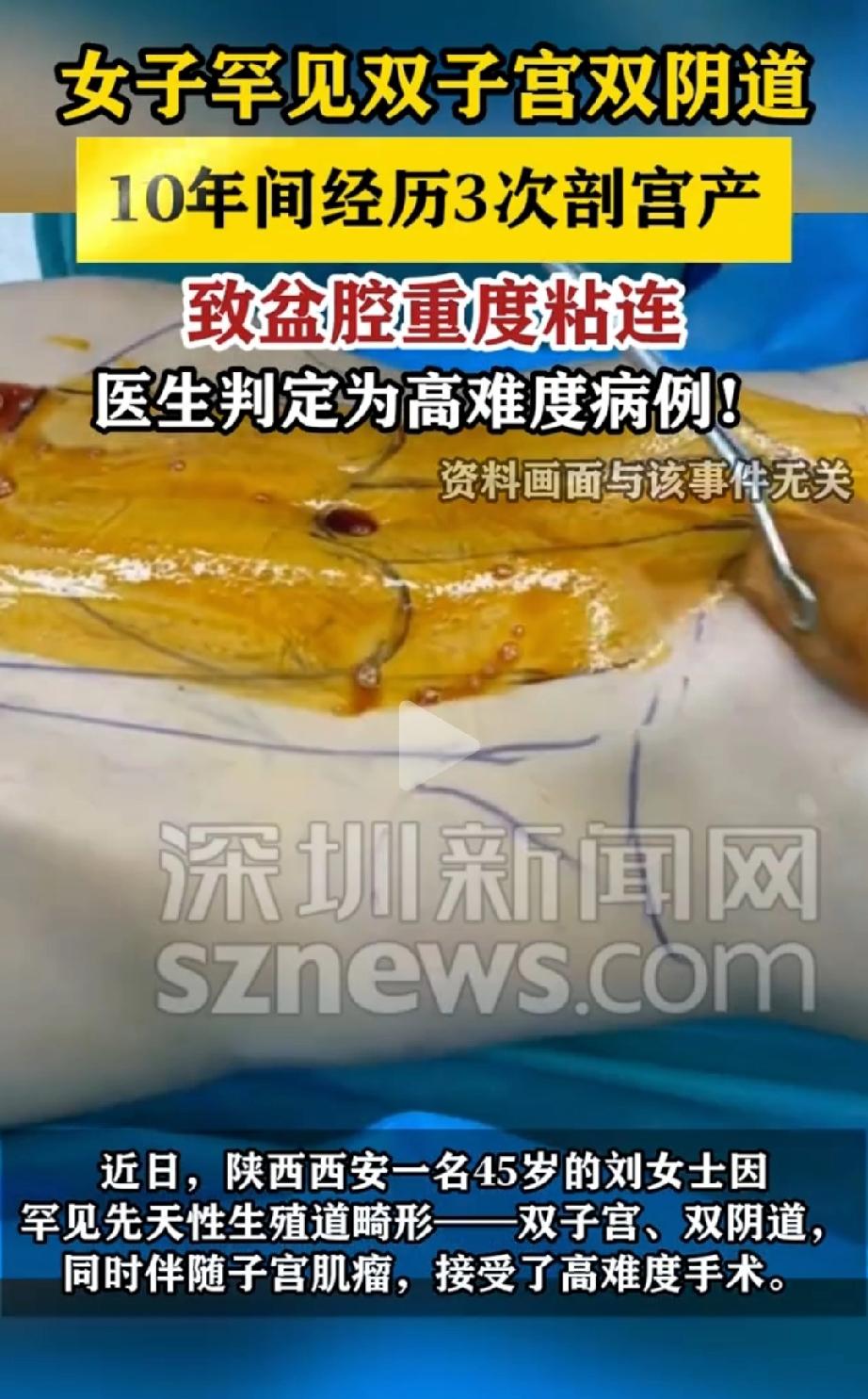 太罕见了！陕西西安，45岁的刘女士，因罕见先天性生殖道畸形﹣﹣双子宫、双阴道，同