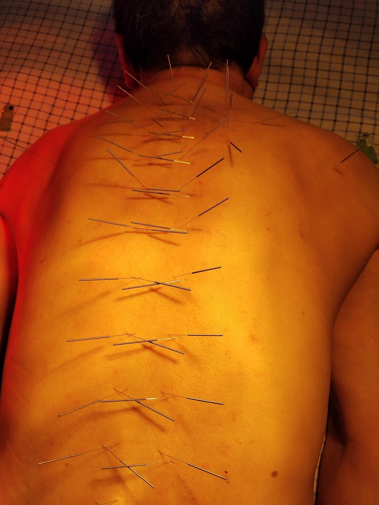 传说中的《吴公·阿是别通疗法》蜈蚣针法，光是听着便充满了神秘色彩。
据说蜈蚣针法