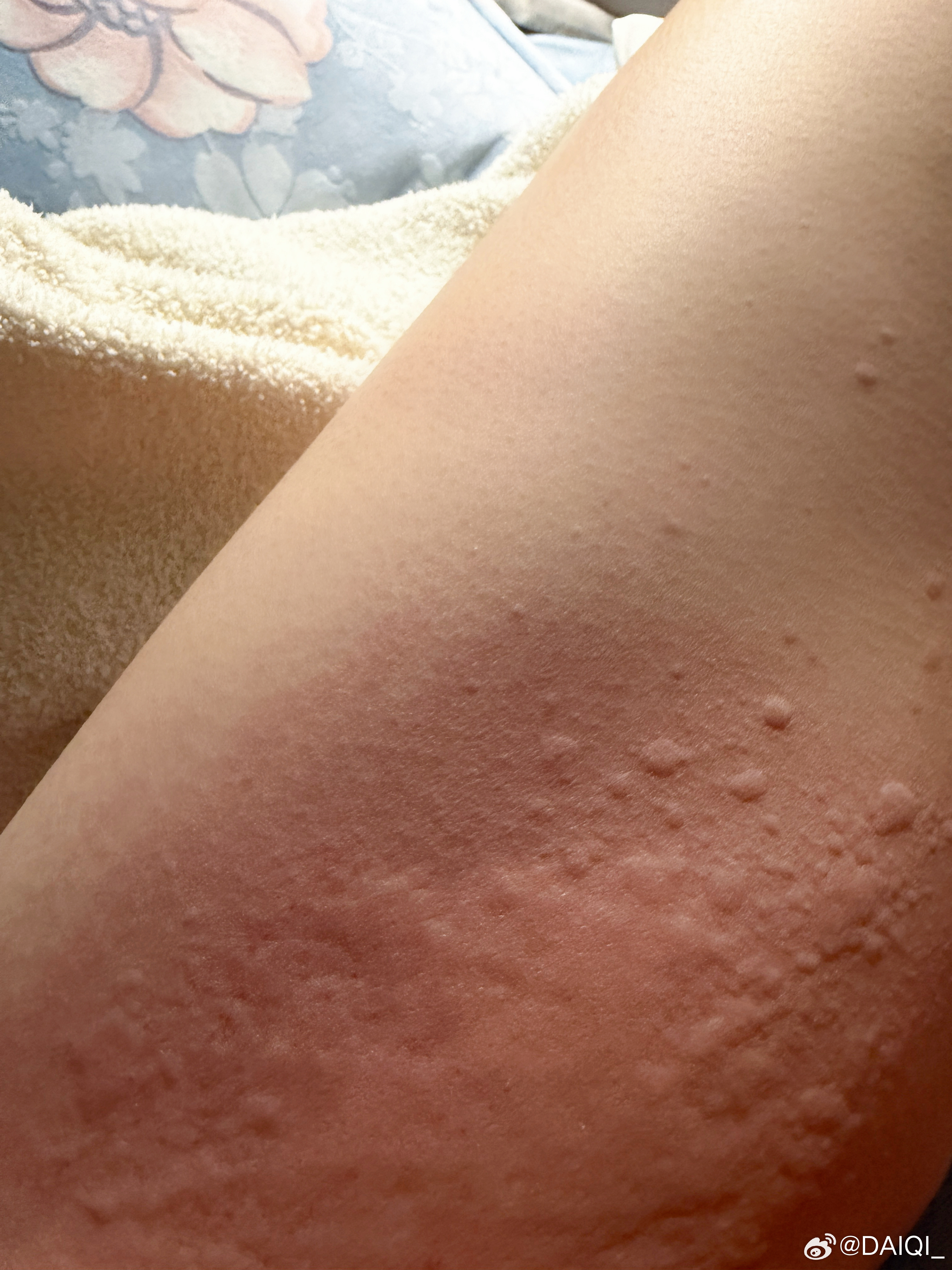 压力大 免疫力低到浑身过敏