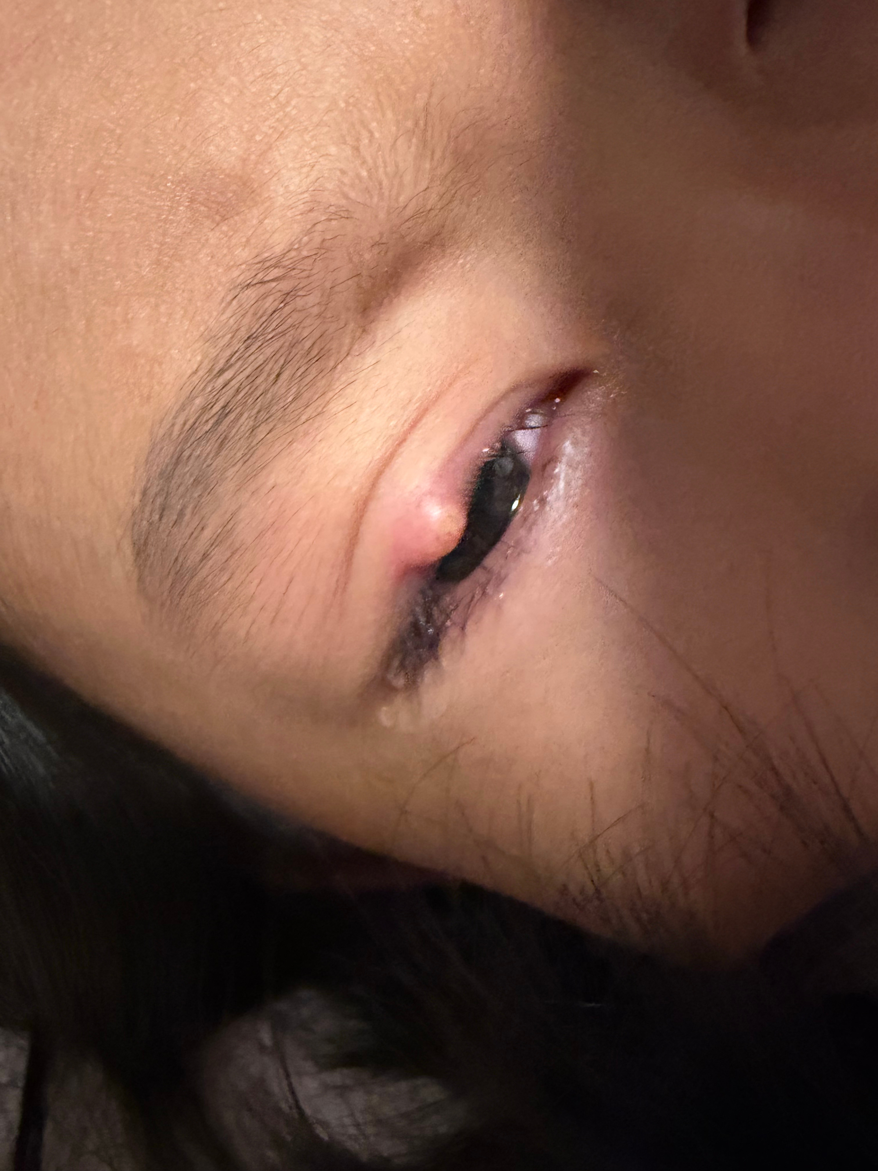 可怜的娃又又又又长麦粒肿了，这次一发现就热敷涂药，但是依然挡不住的长势……因为这