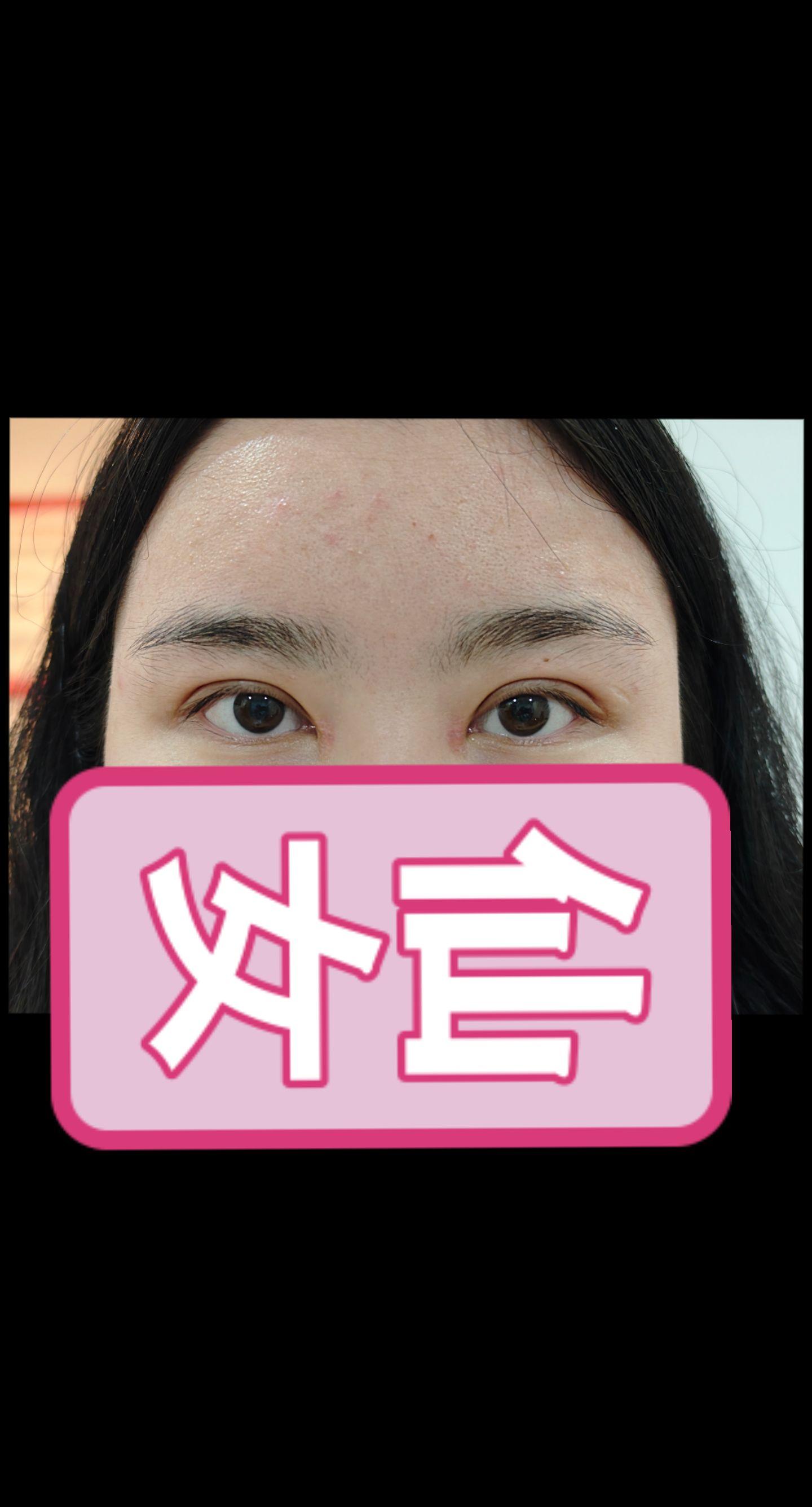 好看的作品当然要分享啊。24年5月21日做的双眼皮，今天回来复诊啦