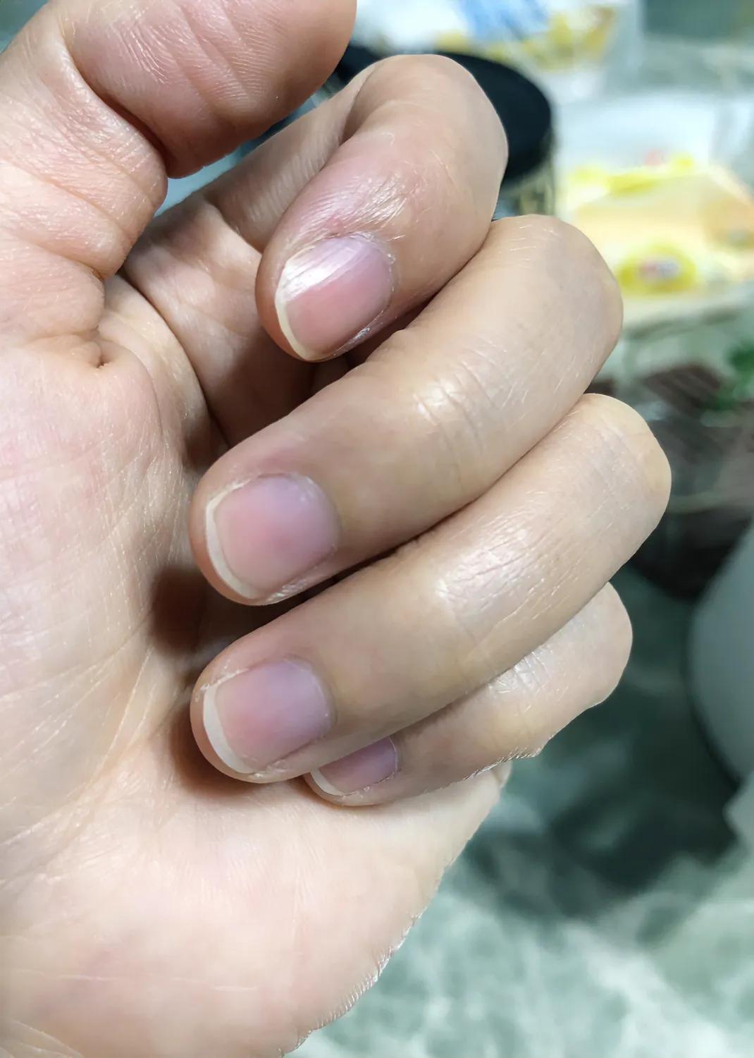 仔细研究了下，其实每个手指都没有月半牙 #手指#