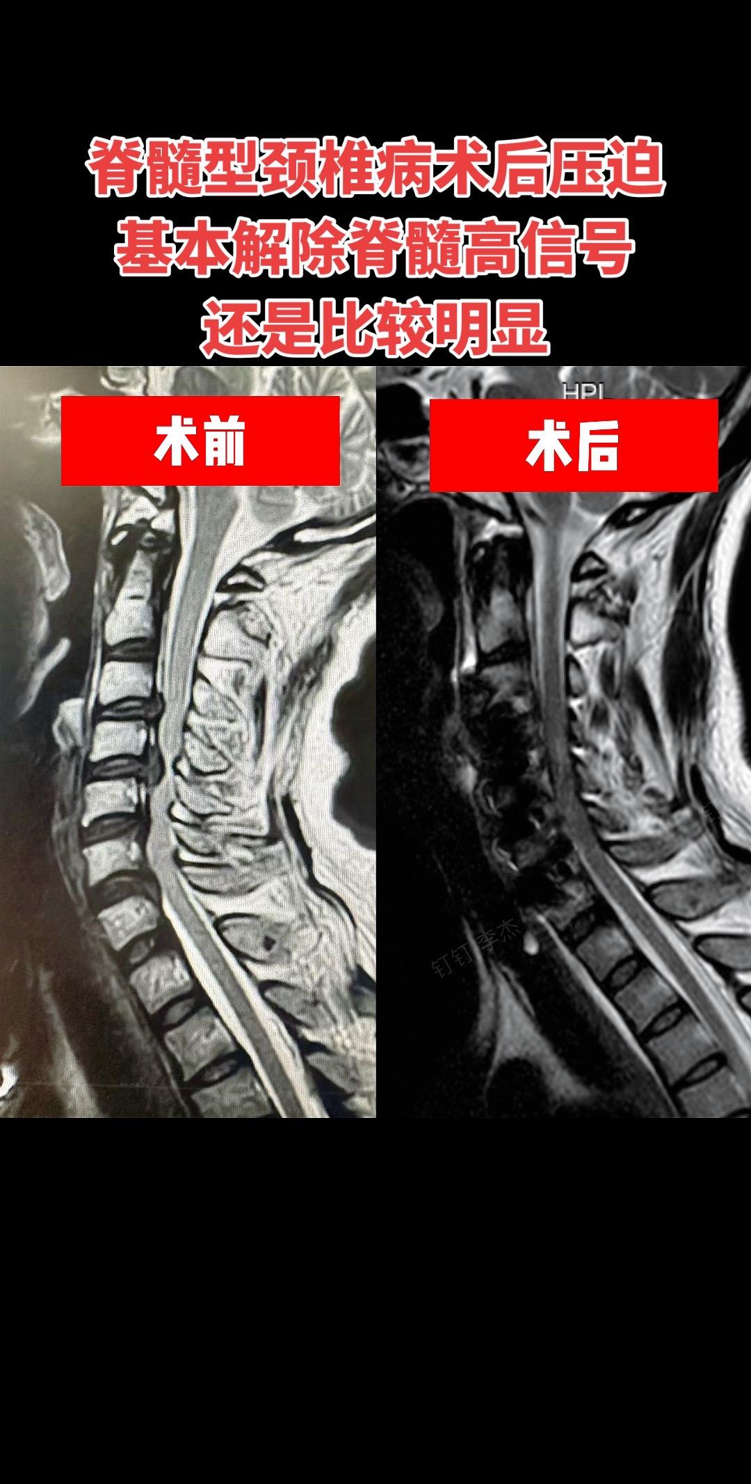 脊髓型颈椎病。脊髓型颈椎病一定要早治疗，这是上周那个脊髓压迫非常严重的...