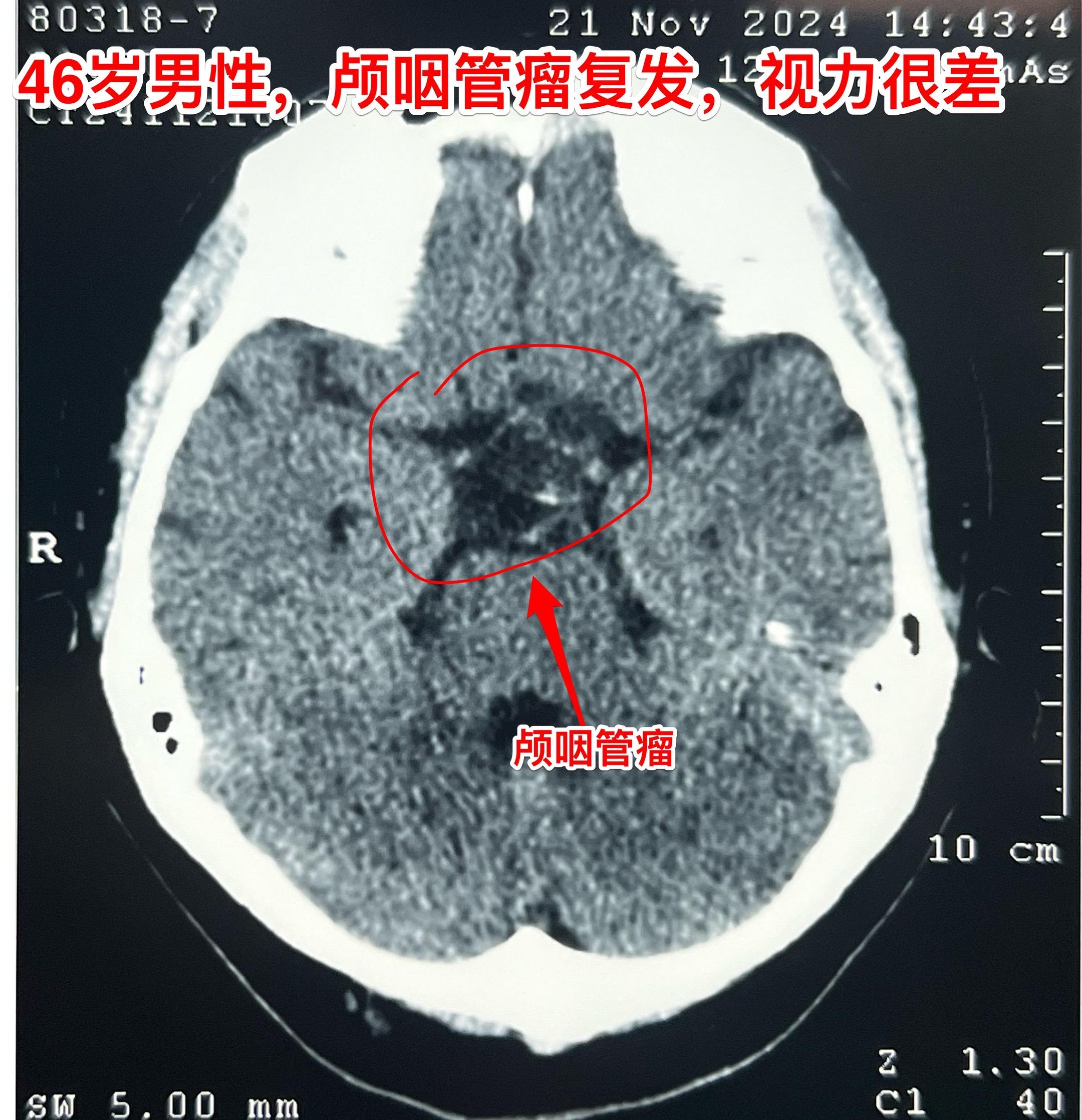 2024年12月2日视频中男主现在上班了。该宜宾市男子因两次经鼻手术切...