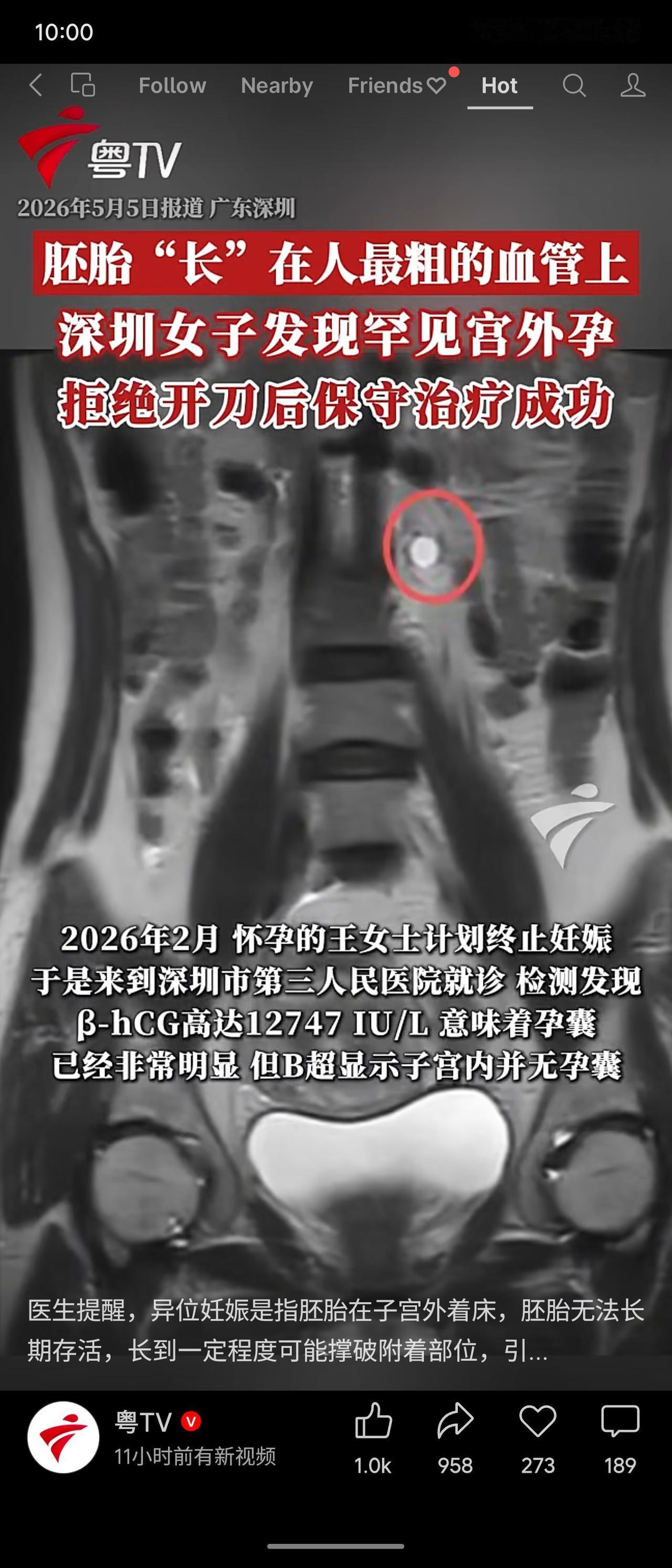 深圳一女子发现罕见宫外孕，胚胎长在人体最粗的血管——腹主动脉上。医生提示手术切除