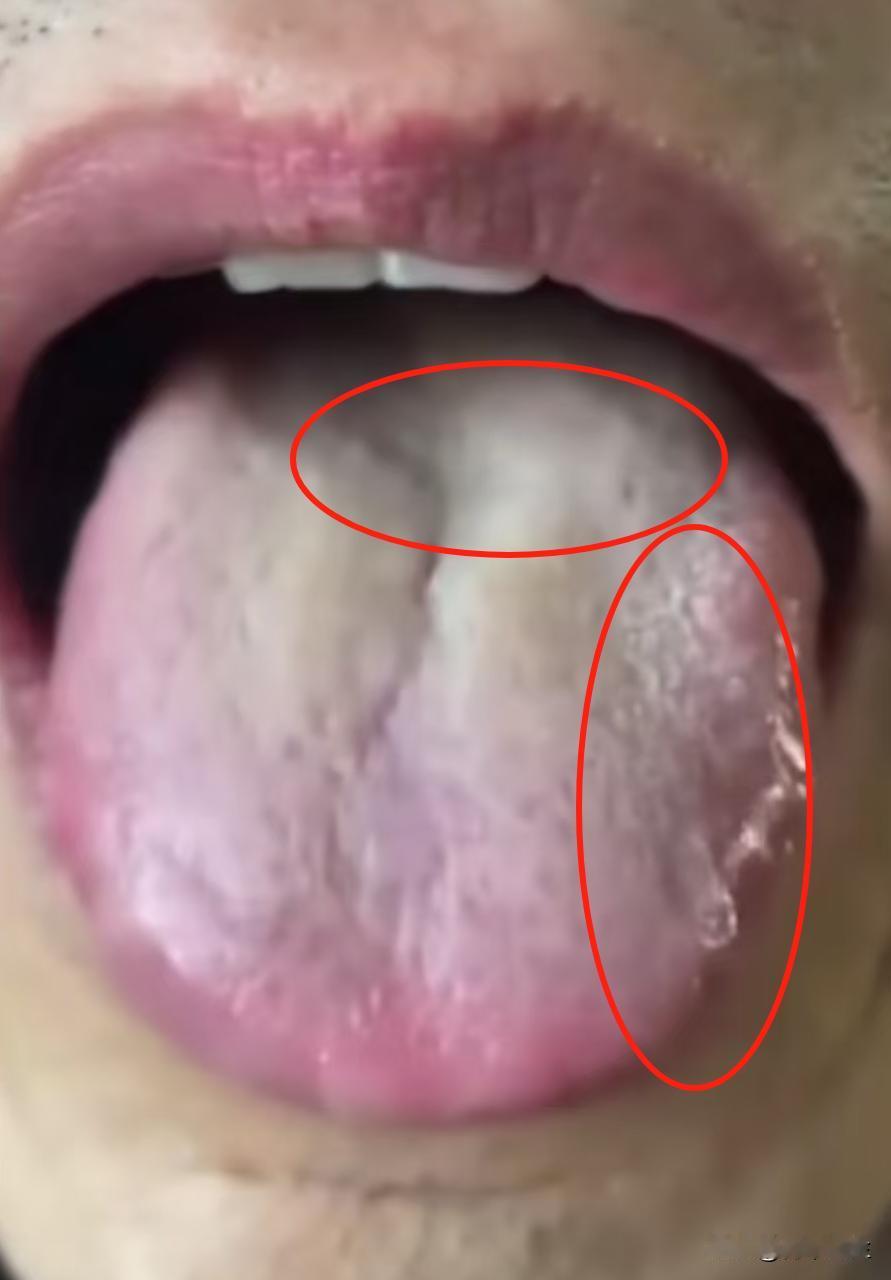 舌尖红，舌根白，舌苔厚腻，湿热重，送你一方，清热泻火，健脾祛湿，双管齐下

先来