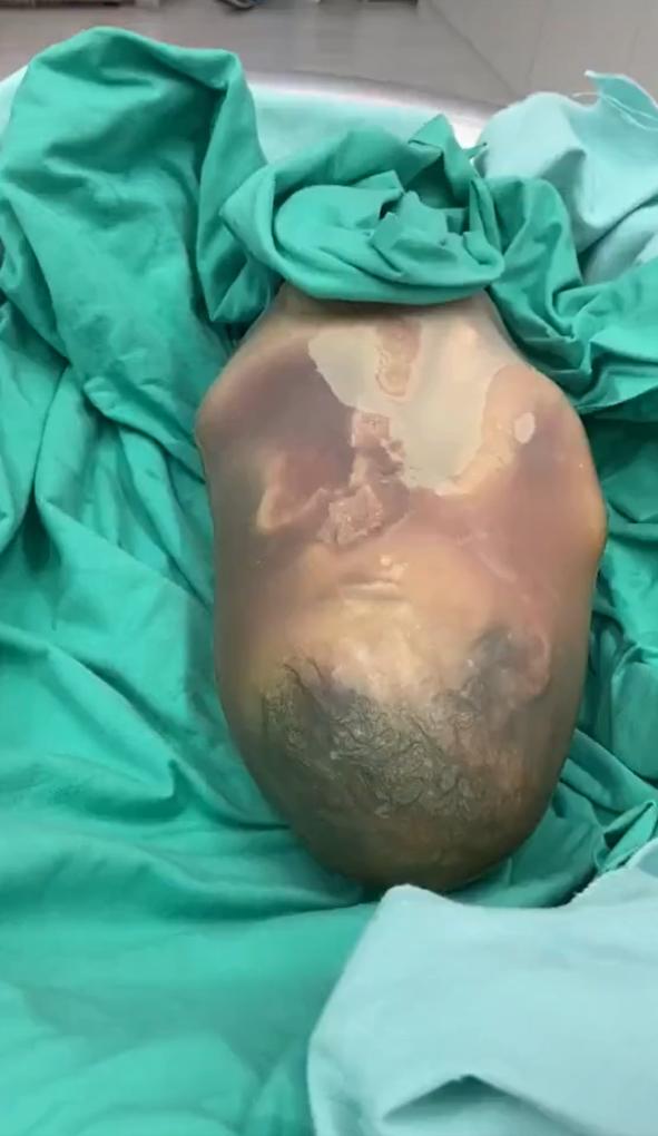 非常罕见“包膜出生”（en caul birth）：国外一名新生儿完全包裹在完好