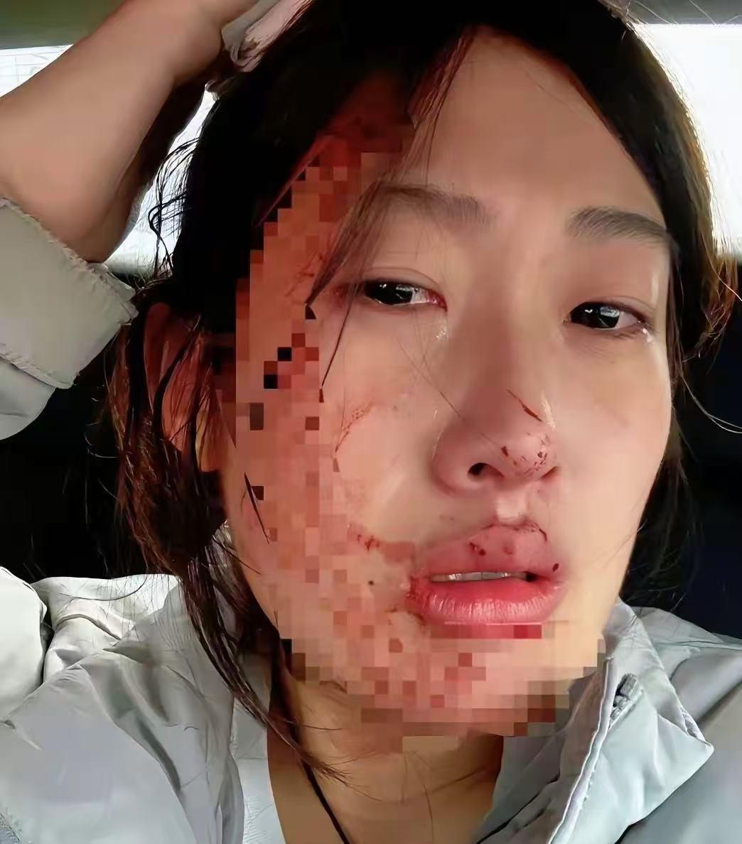 暴力的代价！23岁儿科护士刚入职不久，傍晚6点为感冒患儿输液时，三次穿刺均失败，