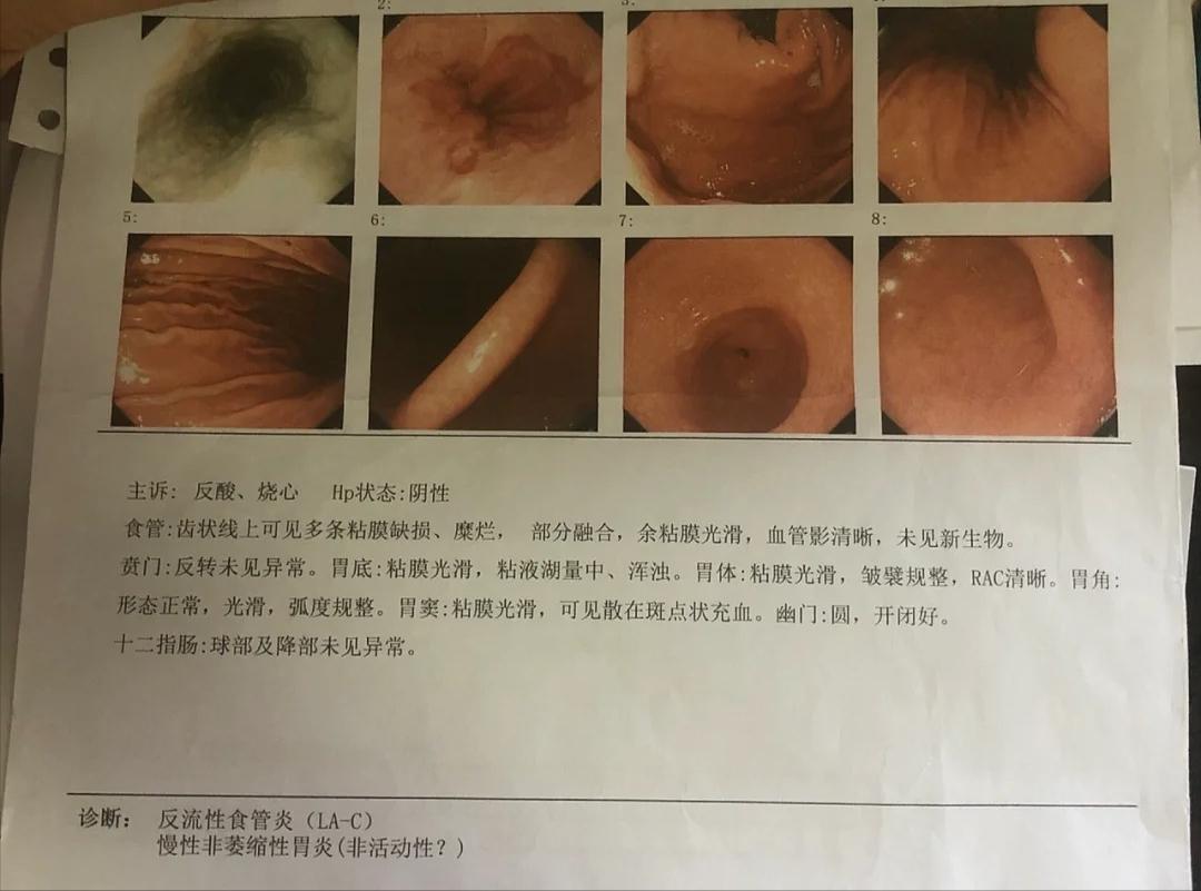 宋金玲：反流性食管炎，四个小药方，反酸烧心打嗝不敢“嚣张”！

大家好，我是北京