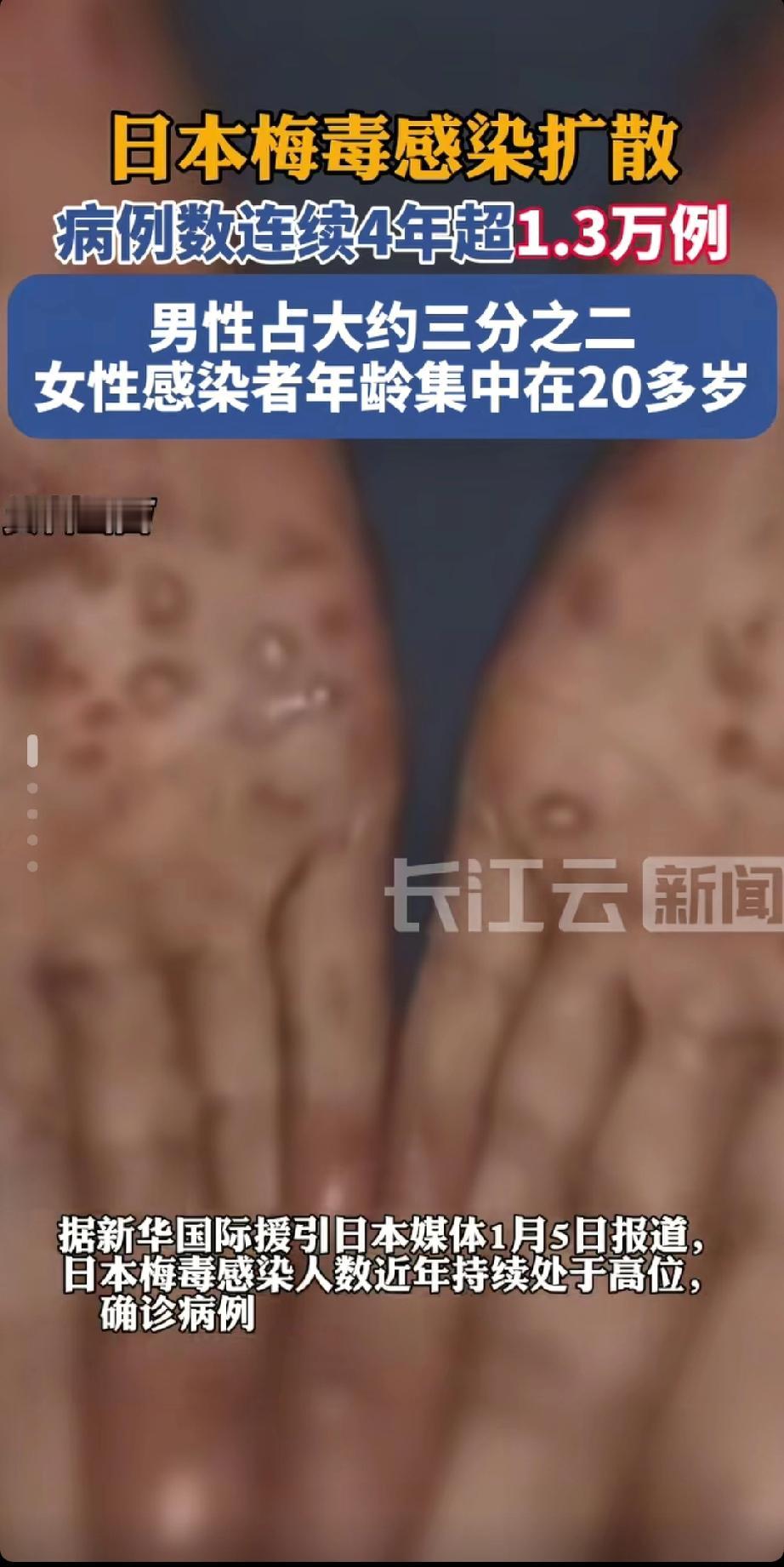 最新消息报道：
由于相关产业发达！
日本梅毒疫感染人数持续增加！
每年确诊人数都