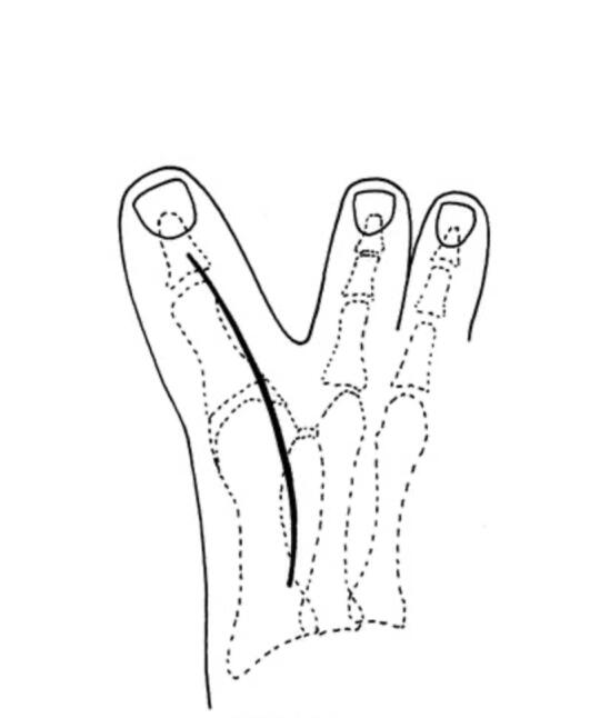 关于拇内翻（下）