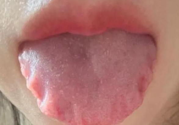 舌边有齿痕不光在脾，也在肝！记住一个中成药，肝脾“补齐”了！

“齿痕舌”大家应
