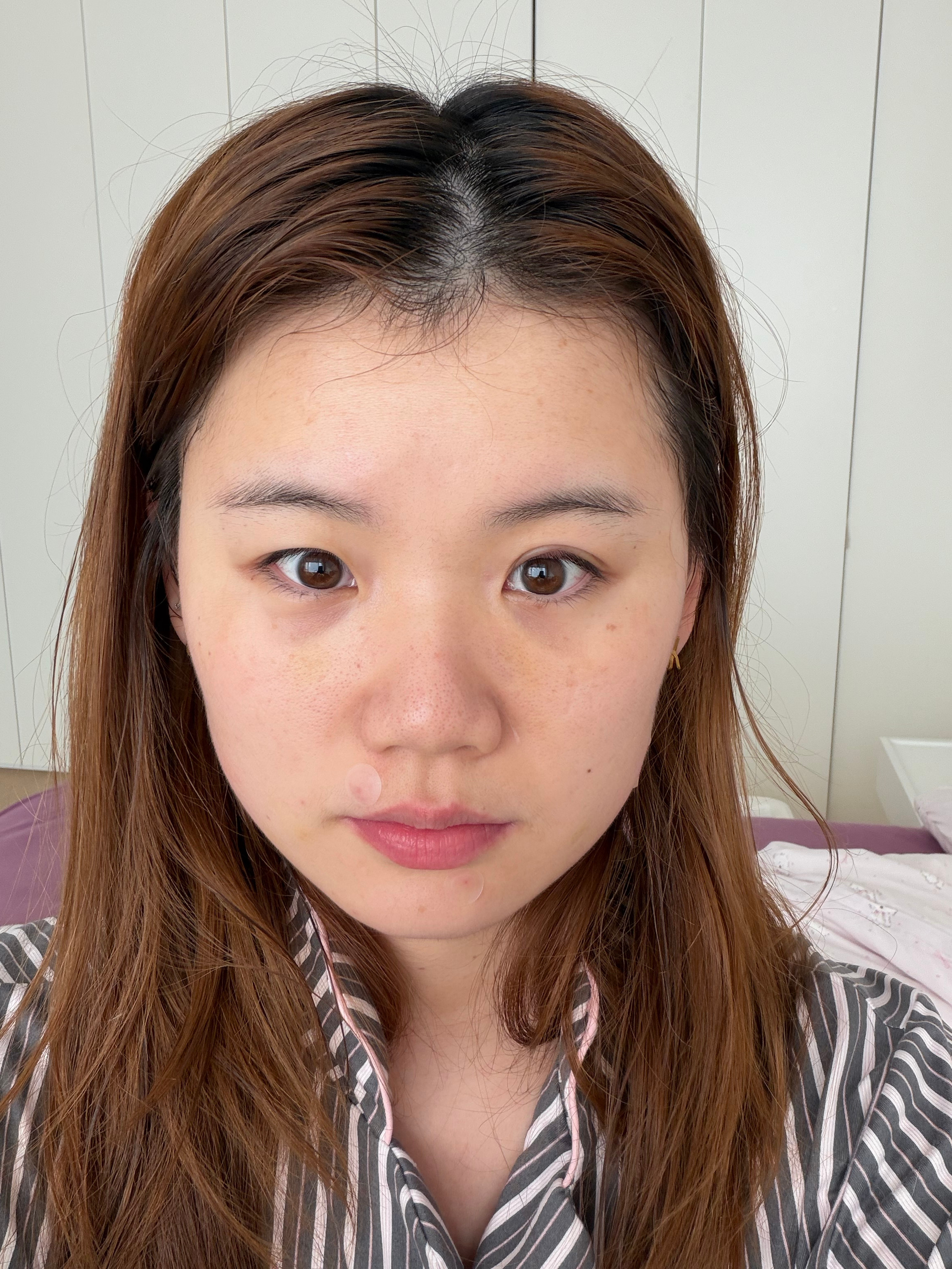 无痛拥有双眼皮（有痛，麦粒肿还怪疼嘞）眼肿成这样明天咋直播