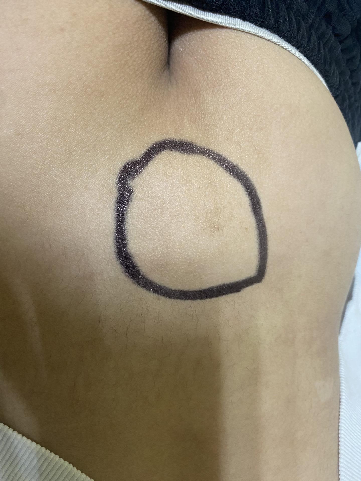 小孩屁股富贵包，危险。早做检查。屁股上长个富贵包，凹陷，一簇毛，小尾巴，都可能是脊髓栓系，脊柱裂。。这个小伙子，小时候是足球队友，青春期后，出现一侧下肢肌肉萎缩，走路高低脚，跑步困难。脊髓栓系