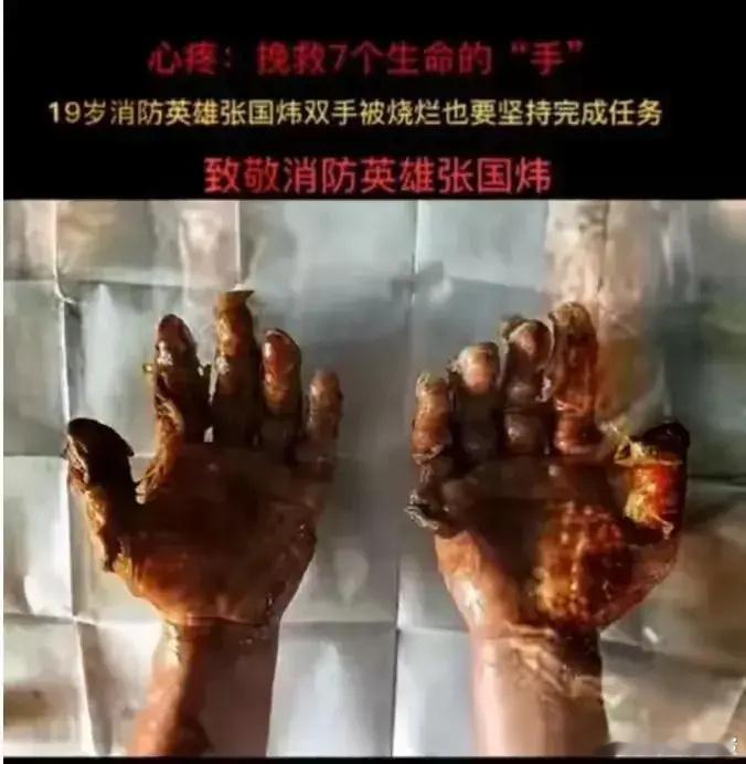 年仅 19 岁的消防员张国炜，在火场中英勇救出 7 名被困者，他的双手却被大火烧