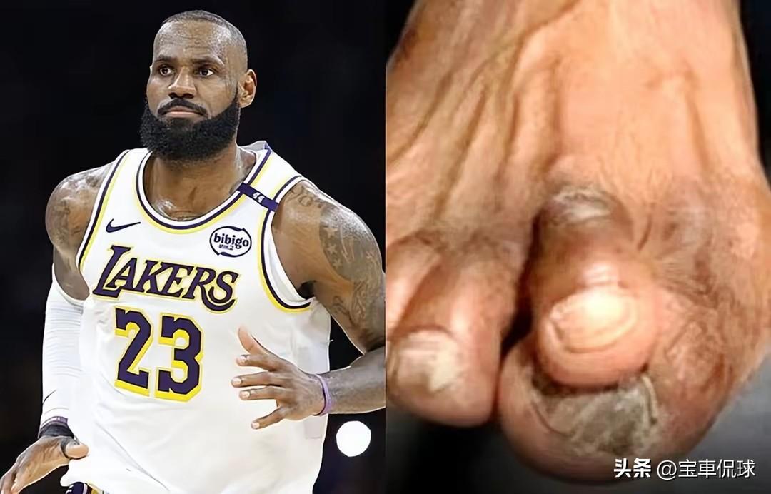 无意间看到NBA球星的脚，感觉到他们承受了太大的压力才会有如此结果。大体重，大身