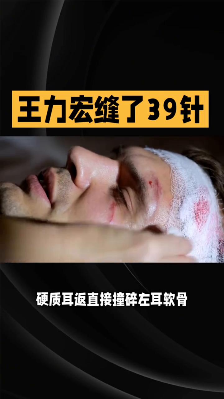 王力宏缝了39针，全网刷屏。
王力宏演唱会意外摔倒，脸部加耳朵整整缝39针，现场