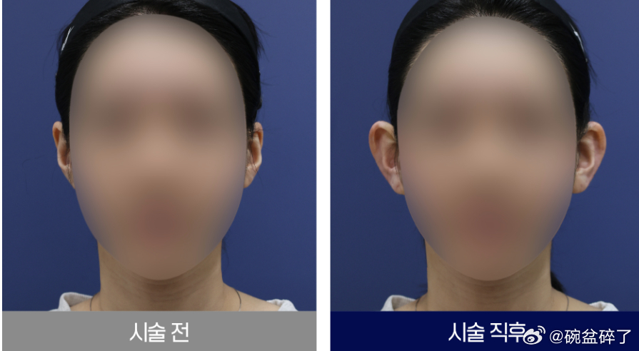 韩国玻尿酸精灵耳案例，可以说是韩国玻尿酸注射最多的医院了。。。 
