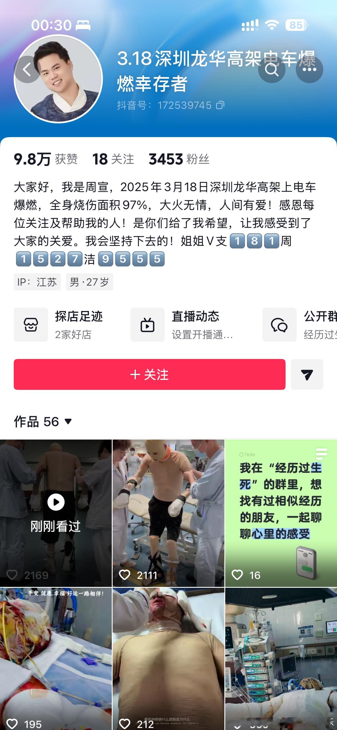 刷到一个人烧伤恢复非常惨，他弟弟也是。因为电车起火爆燃导致的，一年多依然在恢复，