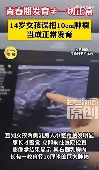 太吓人了！6月16日报道，西安，14岁初二女生洗澡时无意摸到右侧乳房有个硬块，像
