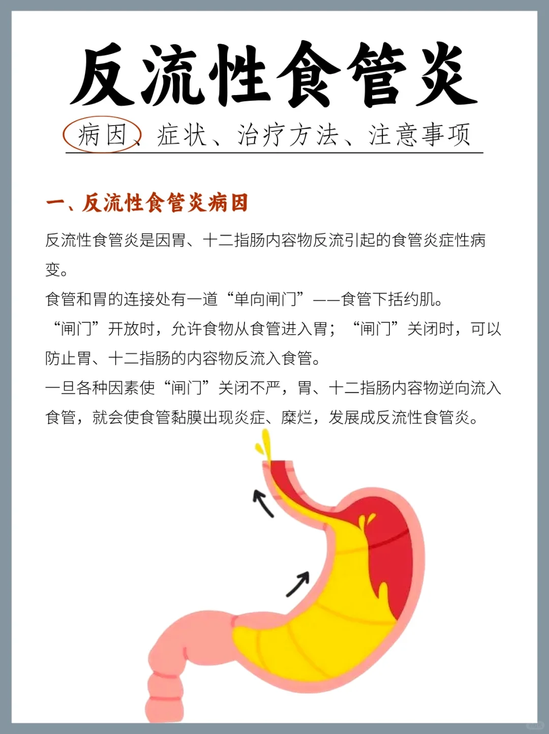 反流性食管炎原因、症状、治疗方法、注意事