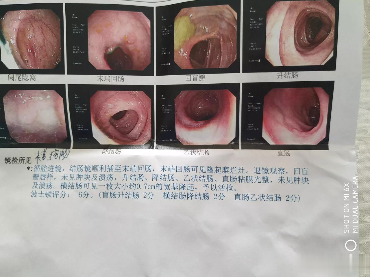 体检做了个肠镜，结果出来了:末端回肠黏膜慢性炎症，横结肠0.7cm增生性息肉。
