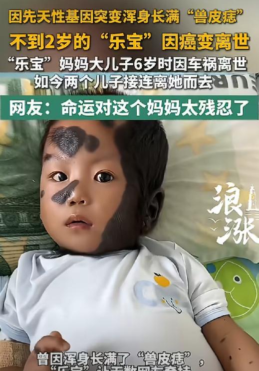 那个全身90%被“兽皮痣”覆盖的男孩乐宝，还是走了。母亲发讣告时写道：一生很短，