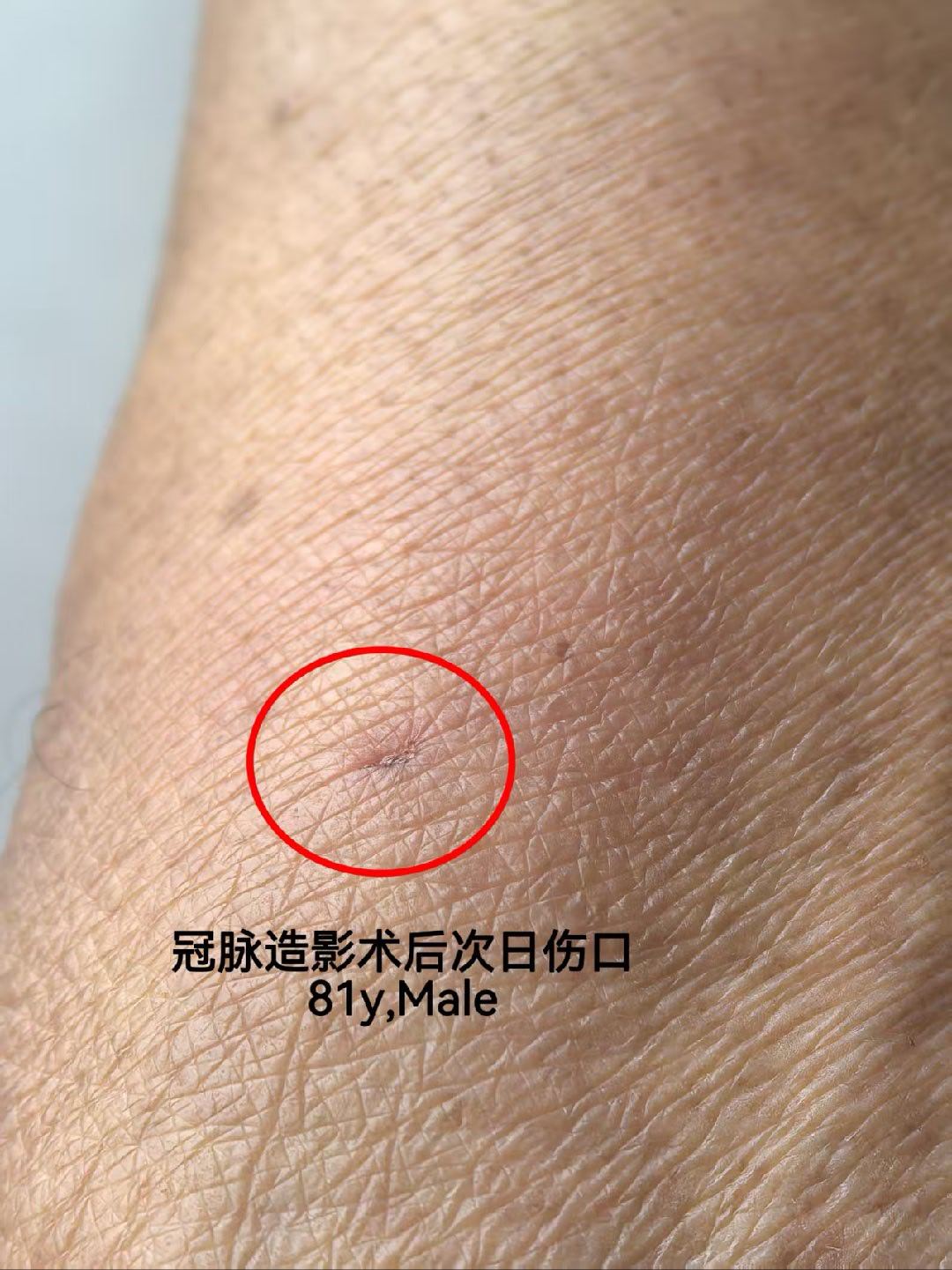 四川大学华西厦门医院心脏科马敏教授2026年9月9日开展五台冠脉微创介入手术创新