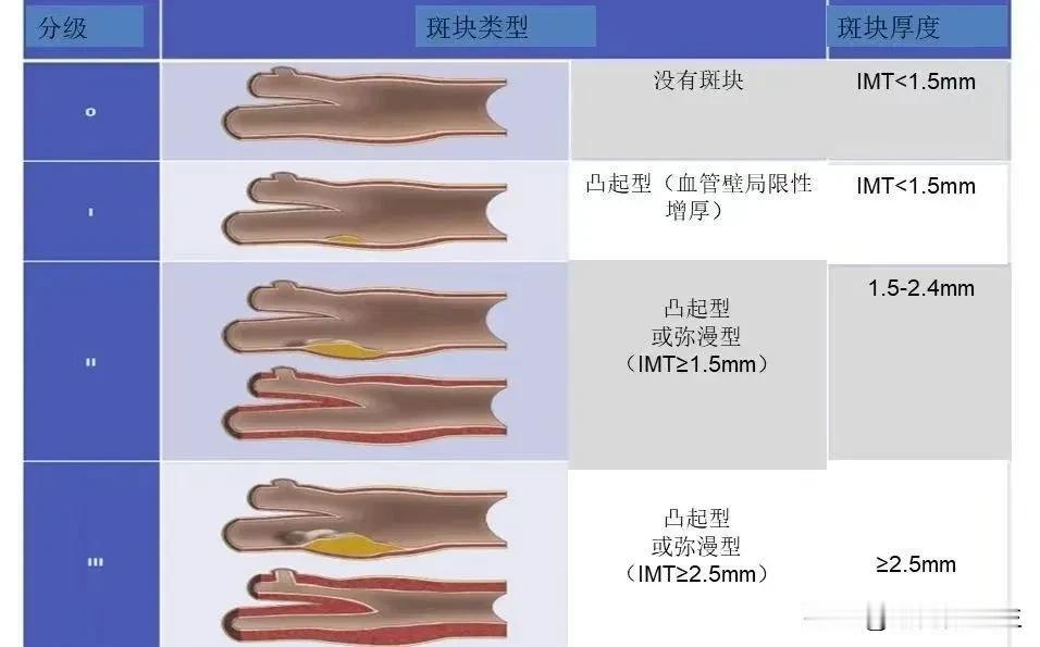 手把手教你看颈动脉超声报告：根据颈动脉斑块回声强度高低，颈动脉斑块大小、形态厚度