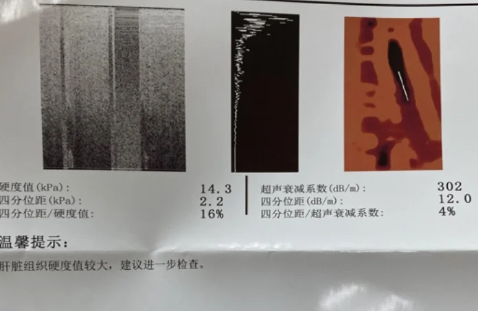 救命！这肝脏检查单谁看得懂啊！