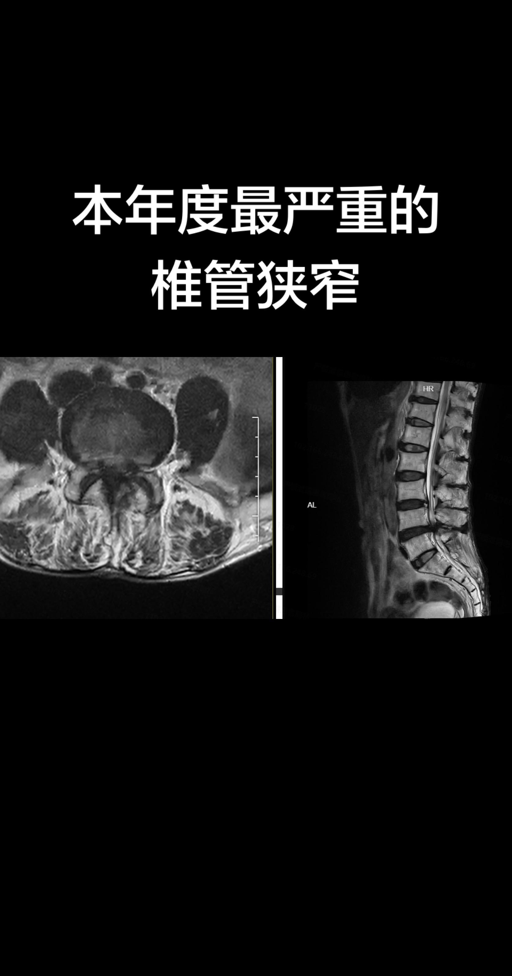 本年度最重的腰椎椎管狭窄。听朋友的话，听邻居的话。就是不听医生的话，非...
