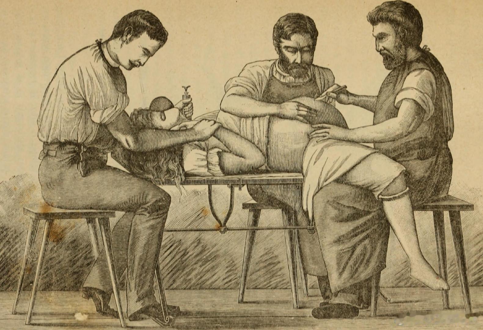 历史知识 1894年的医学插图《卵巢切开术》，来自《妇科疾病的病理学和治疗》（ 