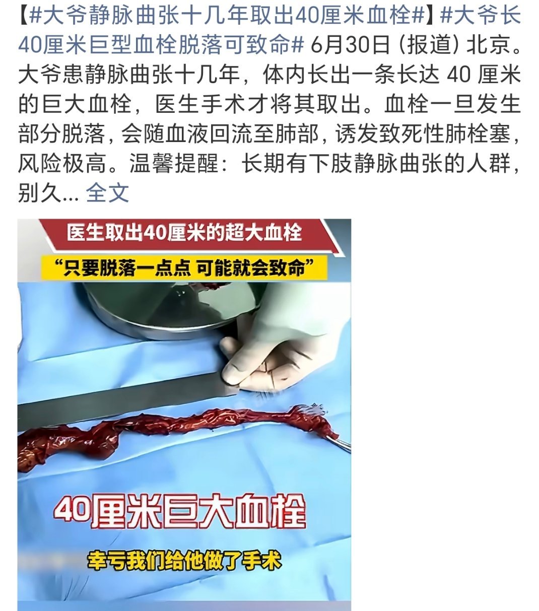 大爷静脉曲张十几年取出40厘米血栓太吓人了居然不打码也是让我看到真东西了刚运动完