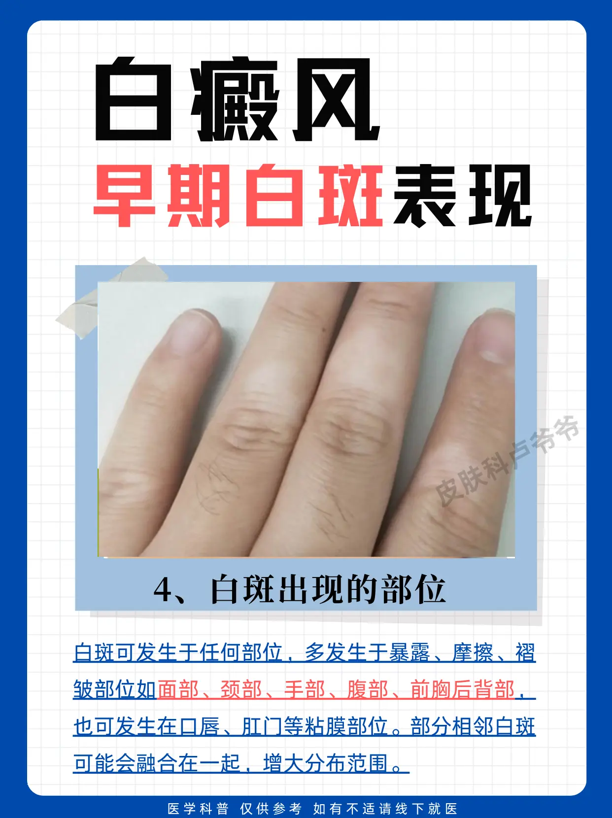 医学科普 白癜风 白斑 江西