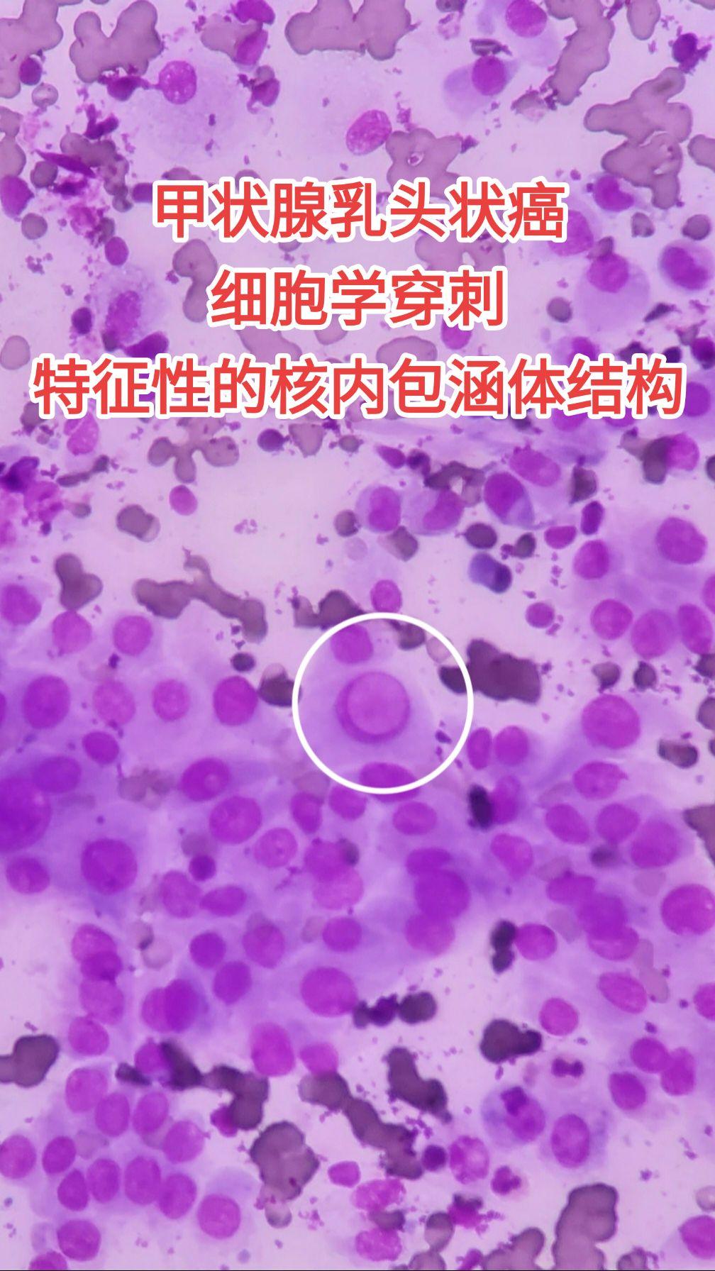 核内包涵体 找个厉害的穿刺医生很重要，假阴性的病例也不少