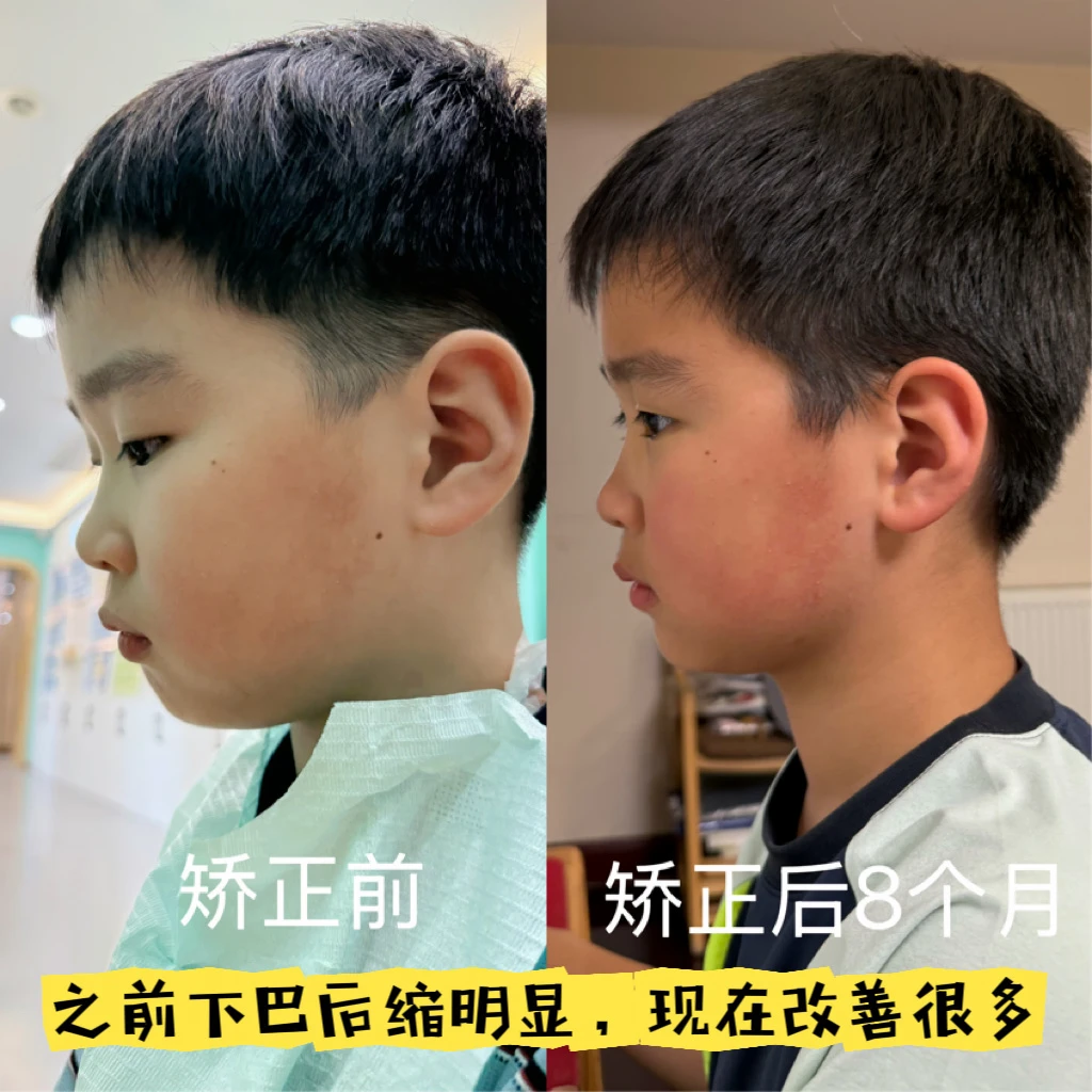 8个月！娃的下巴“长”出了！正畸真不是智商税！