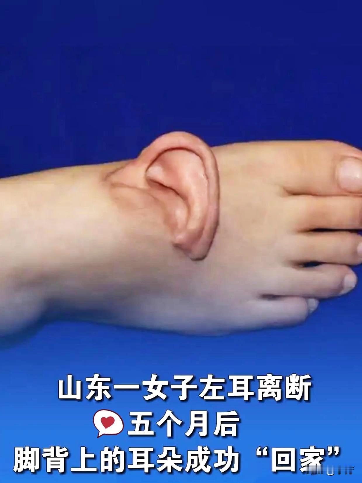 山东孙女士在厂里干活
设备坏了：左耳整个被扯下来
手里攥着那只耳朵送医院
到的时